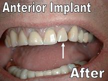 After placement of single implant by Periodontist F Neal Pylant DMD