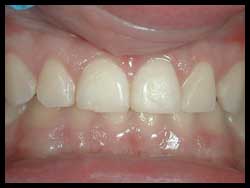 Gingivoplasty_F Neal Pylant Athens GA_Periodontics_Dental Implants