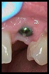 Dental Implants in Athens, GA