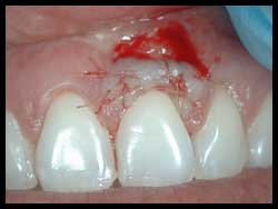 Semilunar Grafts_F Neal Pylant Athens GA_Periodontics_Dental Implants