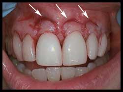 Semilunar Grafts_F Neal Pylant Athens GA_Periodontics_Dental Implants